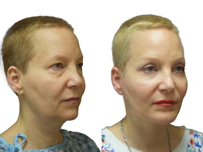 Facelift Before & After Gallery - Patient 172757 - Image 1