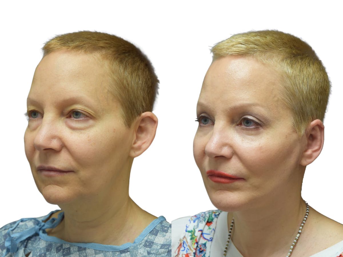 Facelift Before & After Gallery - Patient 172757 - Image 2