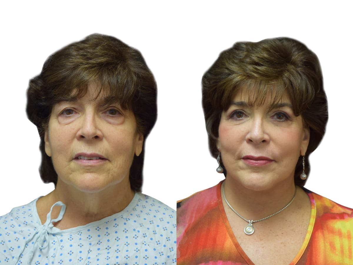 Facelift Before & After Gallery - Patient 343610 - Image 1