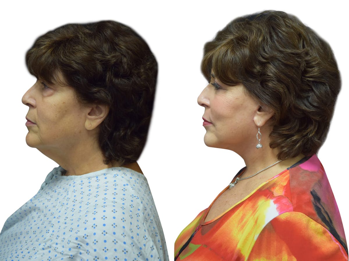 Facelift Before & After Gallery - Patient 343610 - Image 2