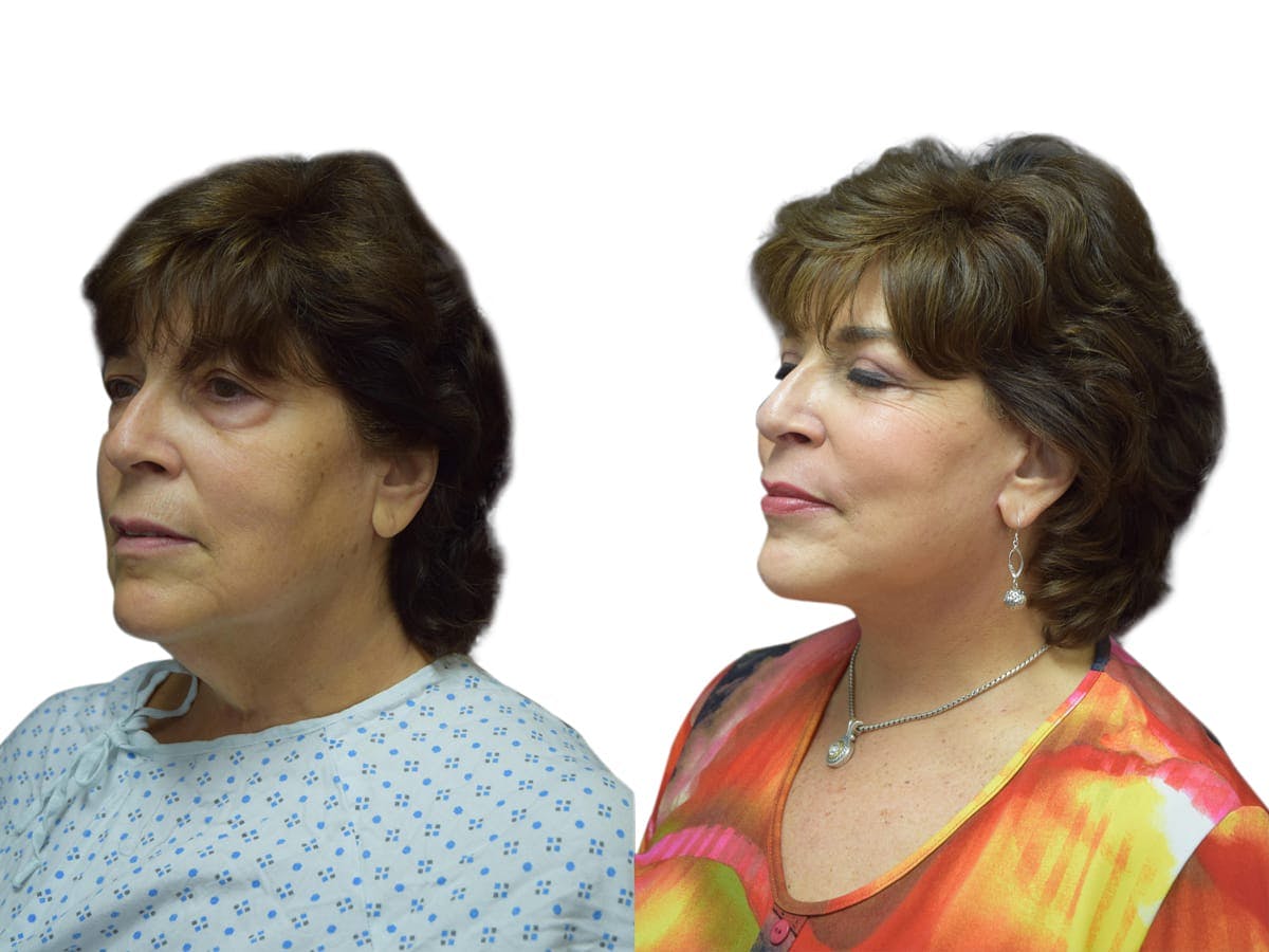 Facelift Before & After Gallery - Patient 343610 - Image 3