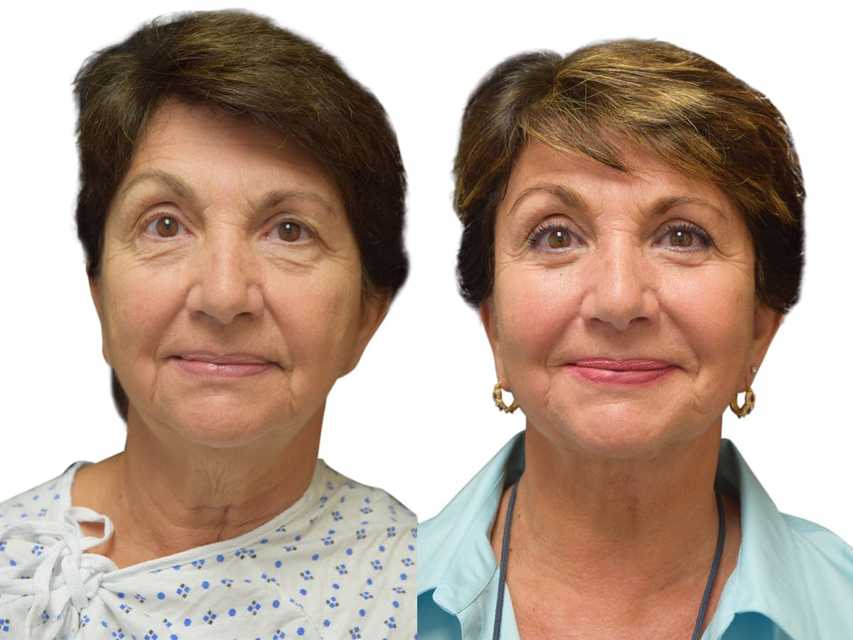 Facelift Before & After Gallery - Patient 245194 - Image 1