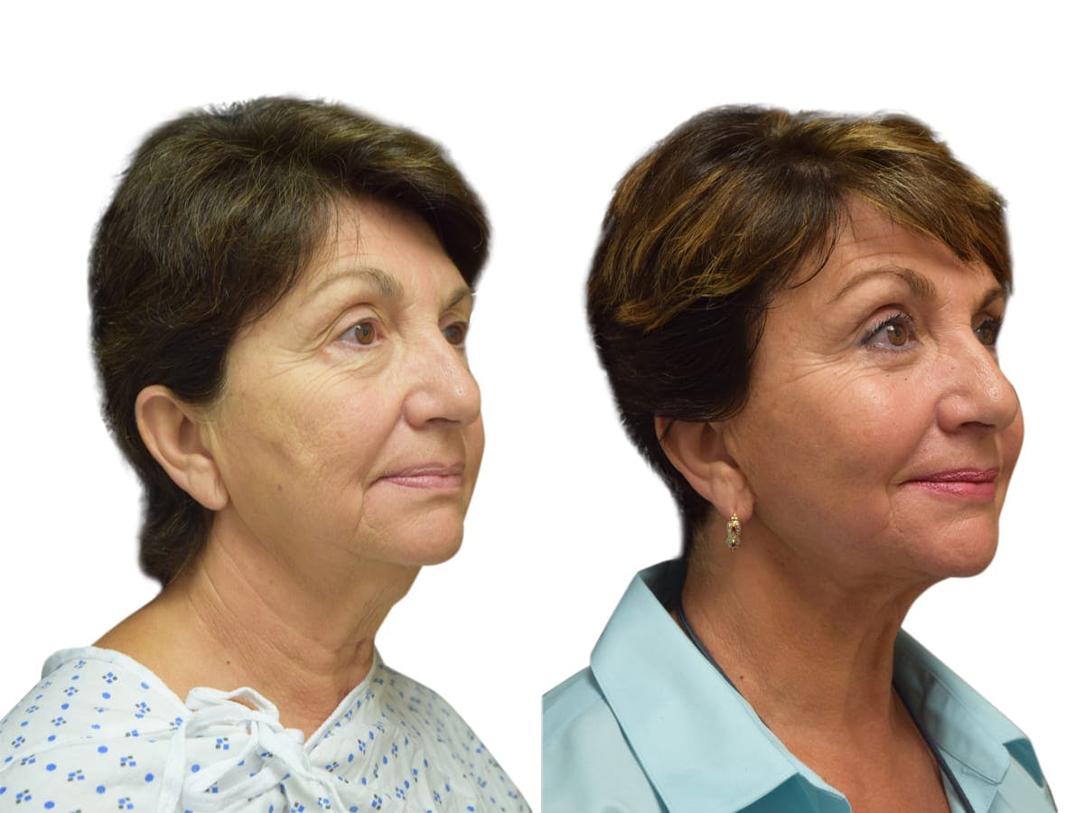 Facelift Before & After Gallery - Patient 245194 - Image 2