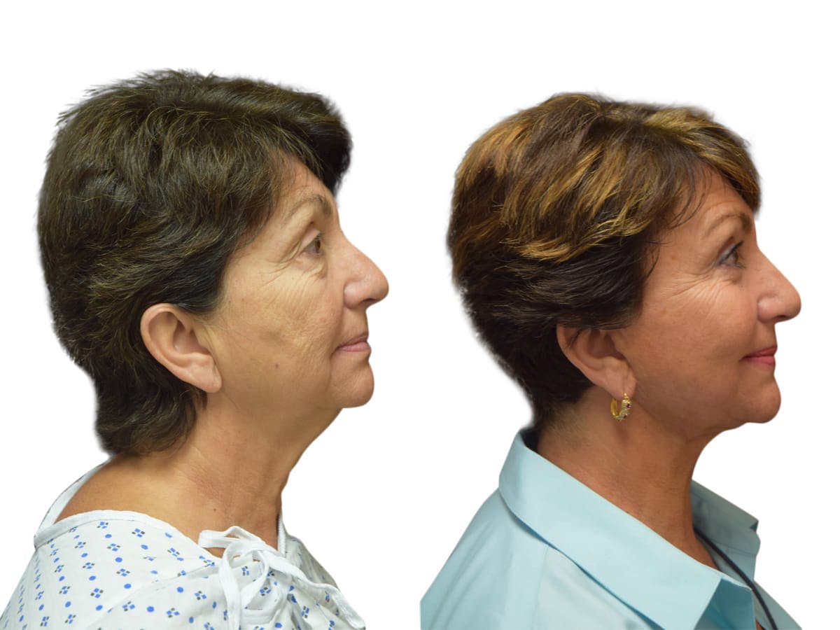 Facelift Before & After Gallery - Patient 245194 - Image 3
