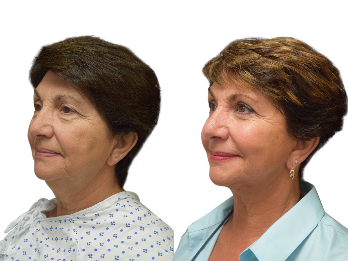Facelift Before & After Gallery - Patient 245194 - Image 4