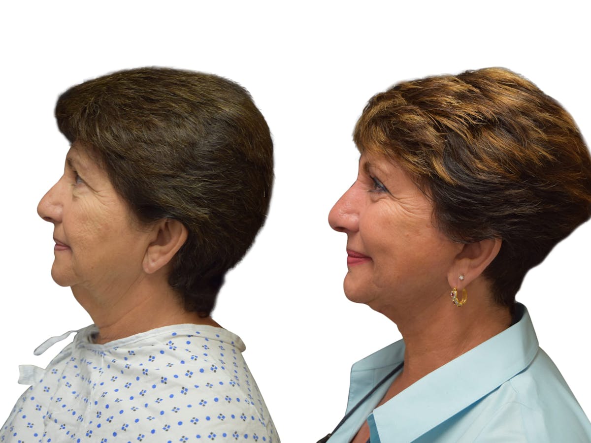 Facelift Before & After Gallery - Patient 245194 - Image 5