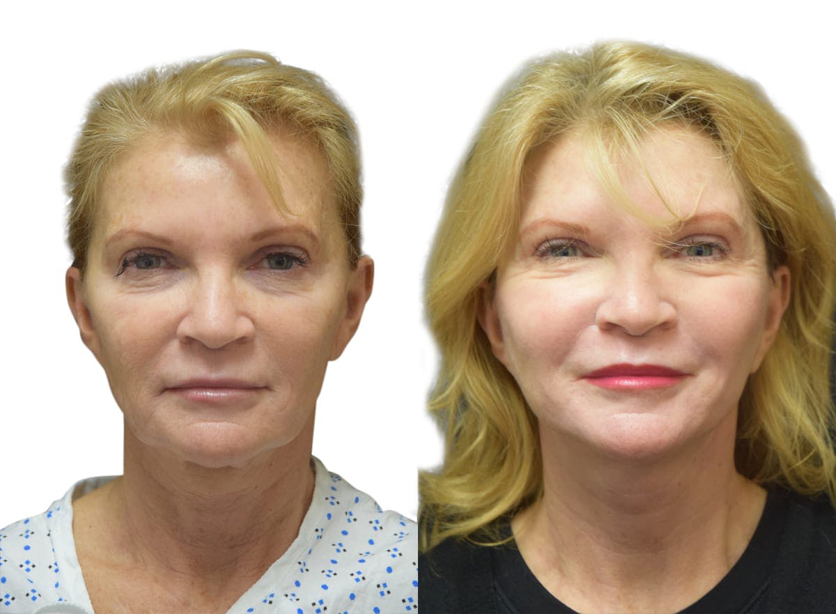 Facelift Before & After Gallery - Patient 111317 - Image 1