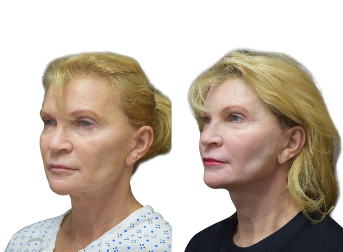 Facelift Before & After Gallery - Patient 111317 - Image 2
