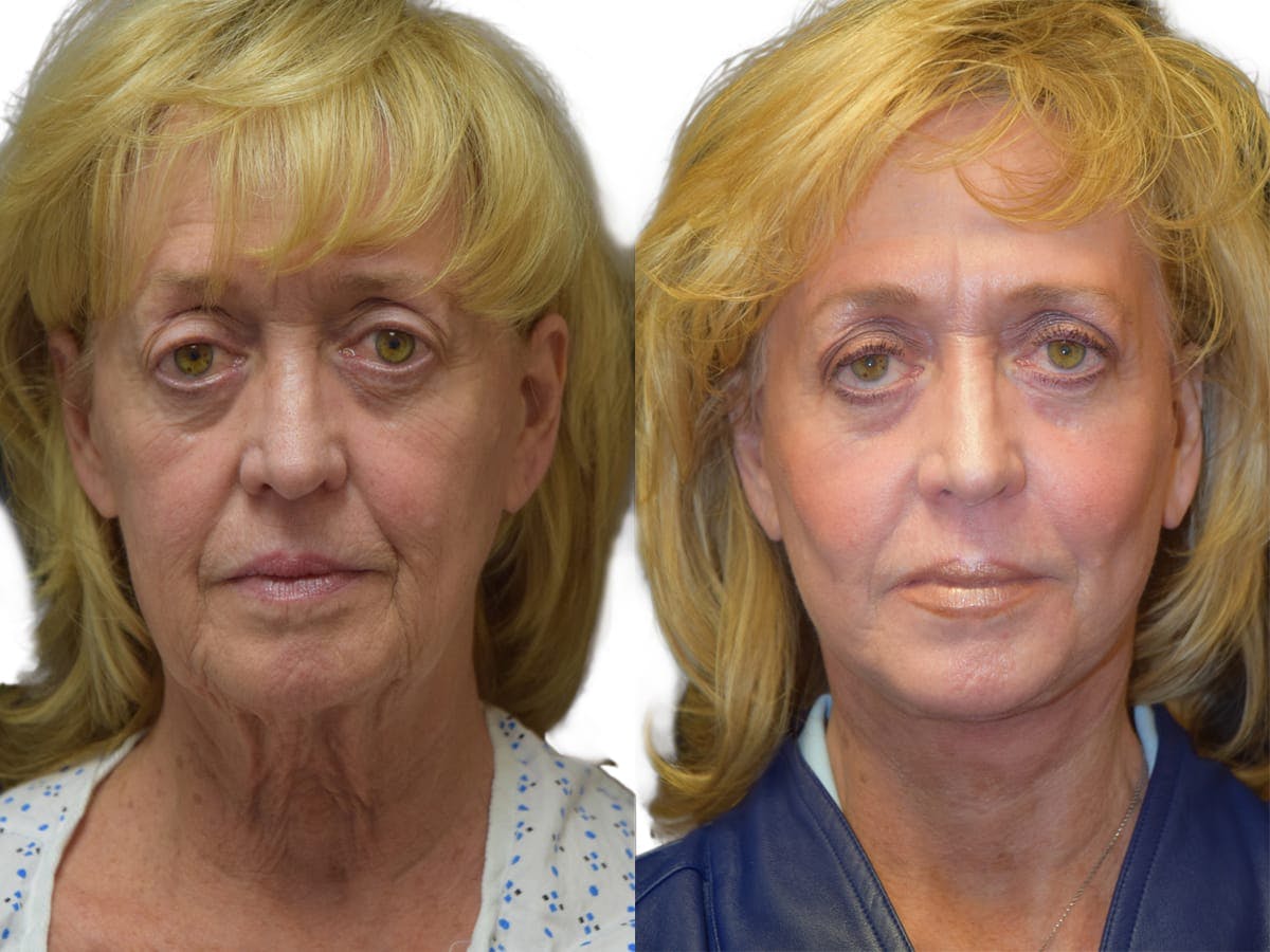 Facelift Before & After Gallery - Patient 574183 - Image 1