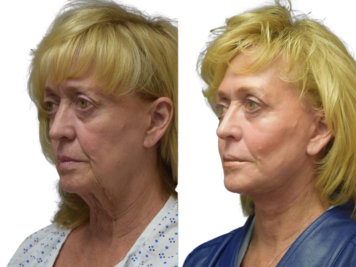 Facelift Before & After Gallery - Patient 574183 - Image 2