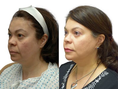 Facelift Before & After Gallery - Patient 713147 - Image 1