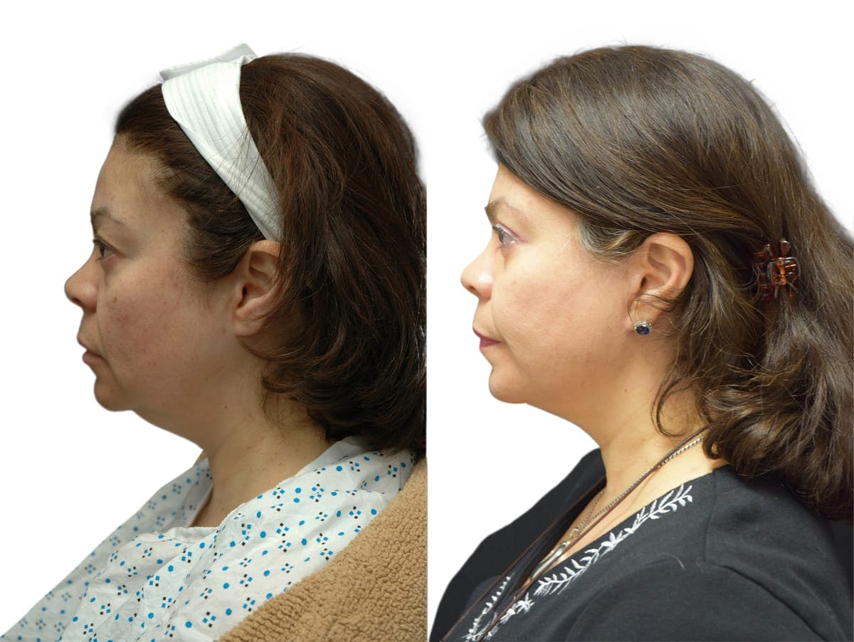 Facelift Before & After Gallery - Patient 713147 - Image 2