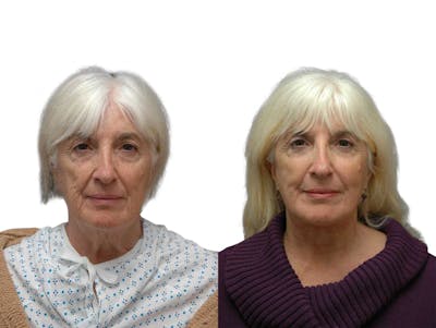 Facelift Before & After Gallery - Patient 294316 - Image 1