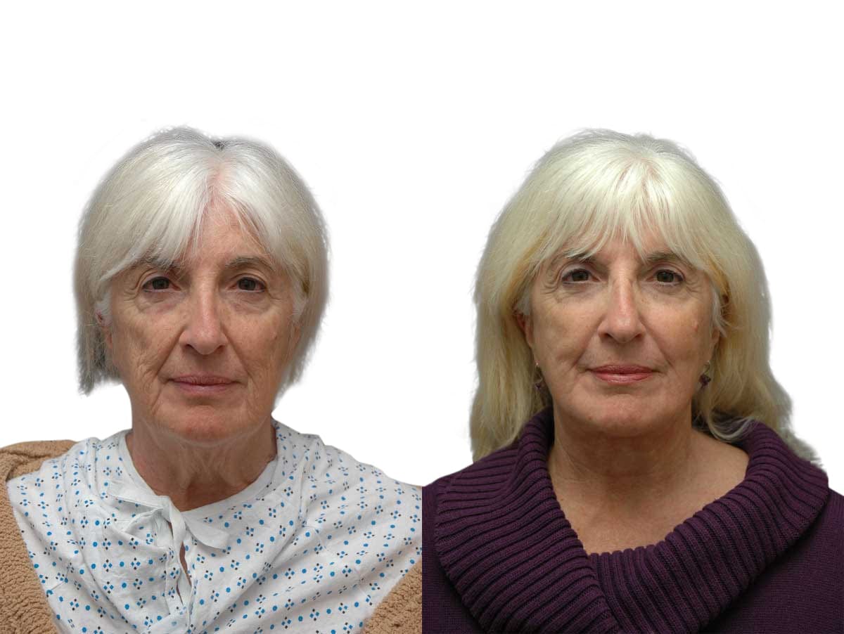 Facelift Before & After Gallery - Patient 294316 - Image 1