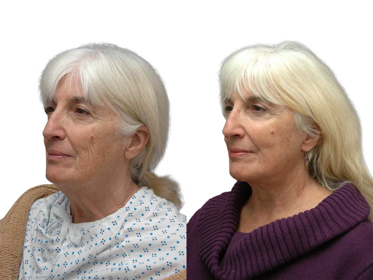 Facelift Before & After Gallery - Patient 294316 - Image 2