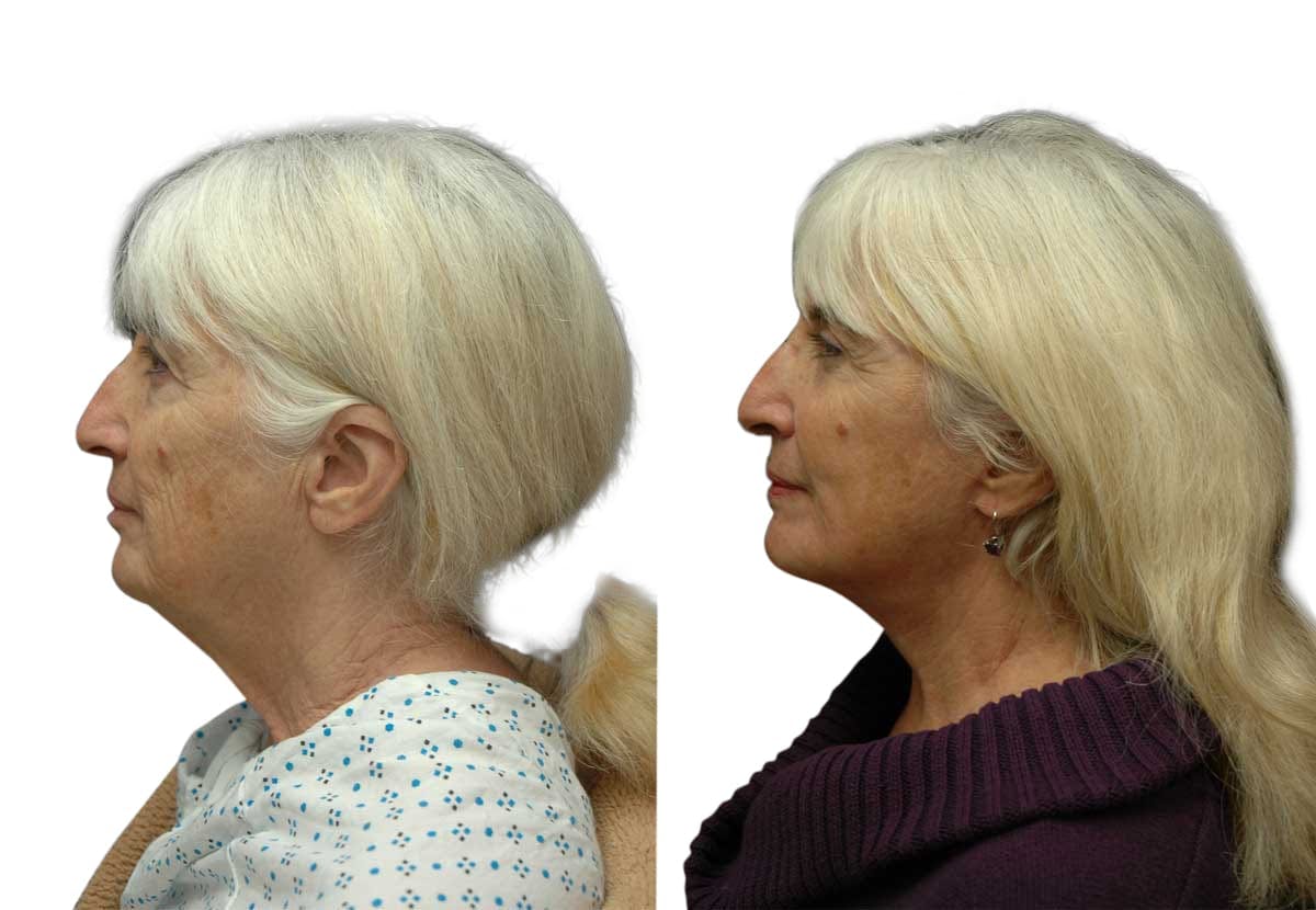 Facelift Before & After Gallery - Patient 294316 - Image 3