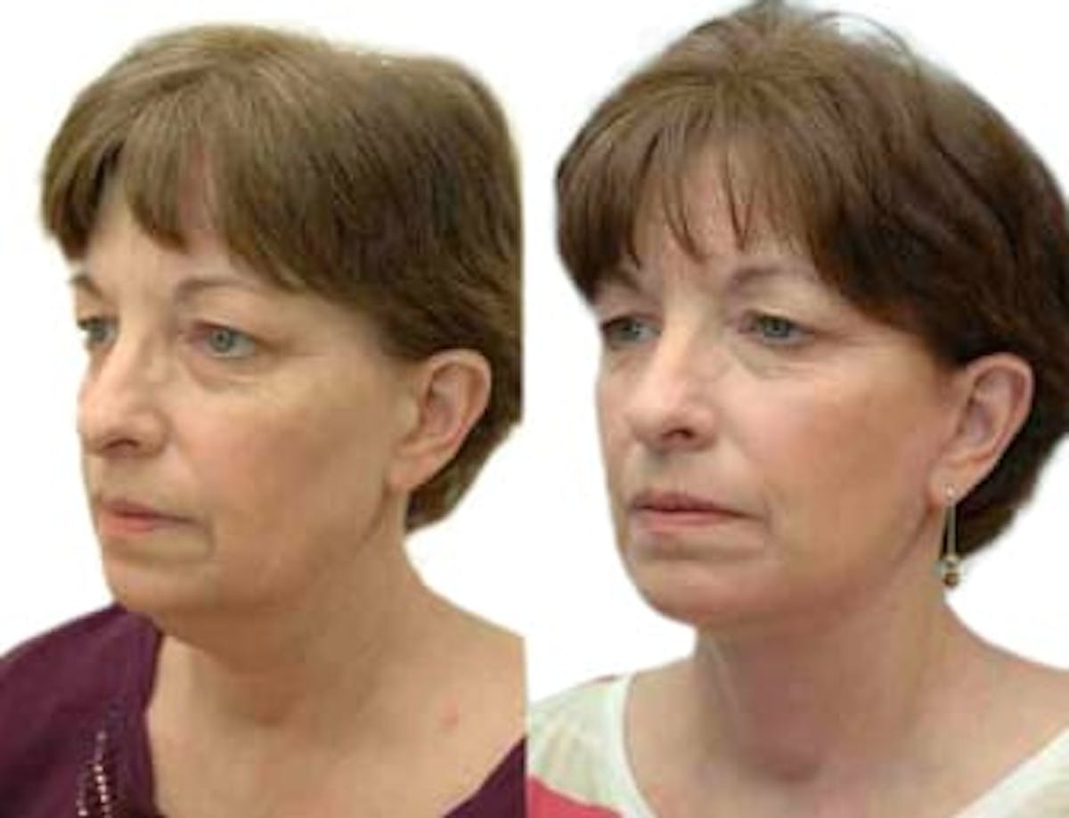 Facelift Before & After Gallery - Patient 377501 - Image 1