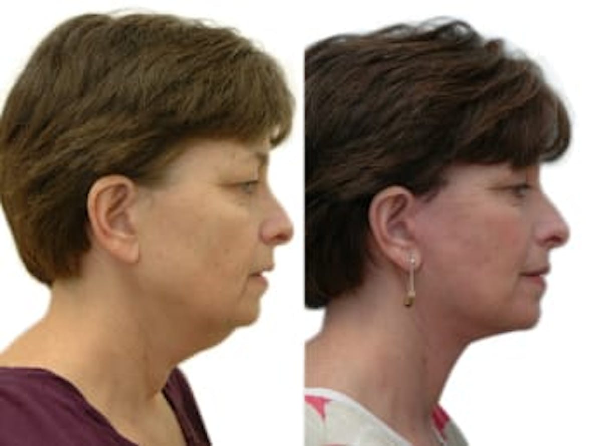 Facelift Before & After Gallery - Patient 377501 - Image 2