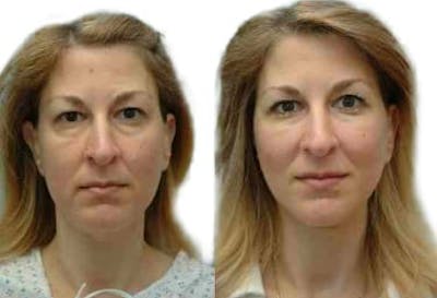 Facelift Before & After Gallery - Patient 101917 - Image 1