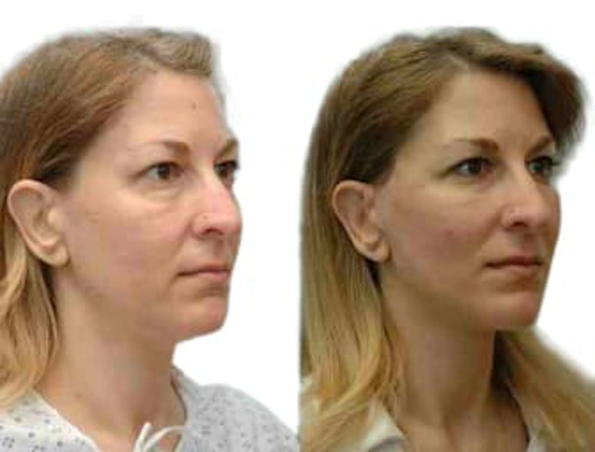 Facelift Before & After Gallery - Patient 101917 - Image 2