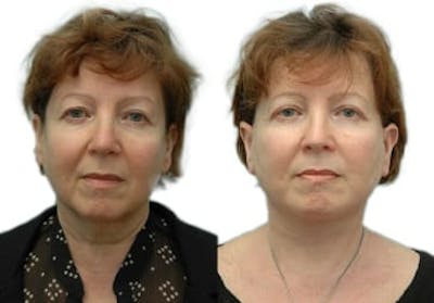 Facelift Before & After Gallery - Patient 257286 - Image 1