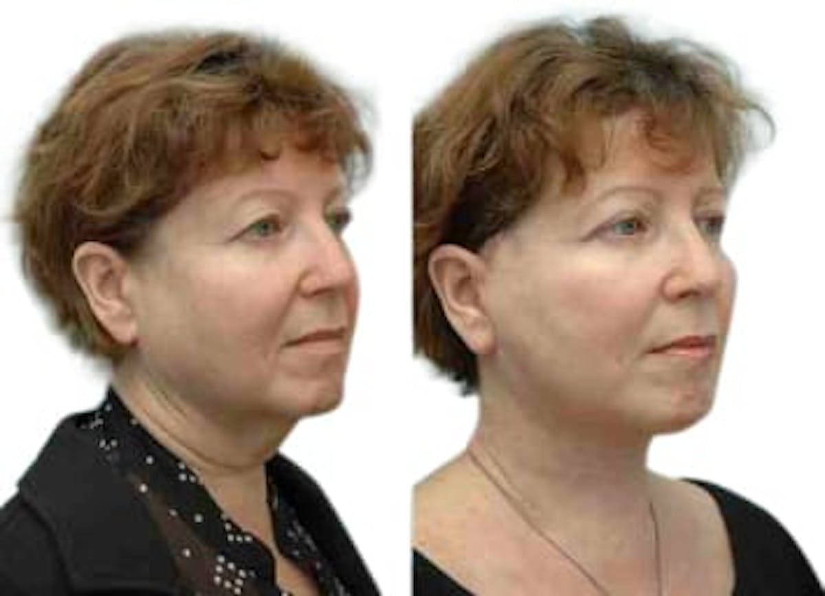 Facelift Before & After Gallery - Patient 257286 - Image 2