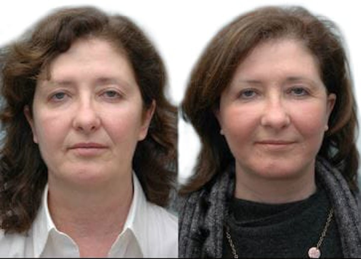 Facelift Before & After Gallery - Patient 307015 - Image 1