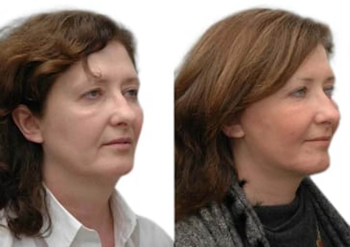 Facelift Before & After Gallery - Patient 307015 - Image 2