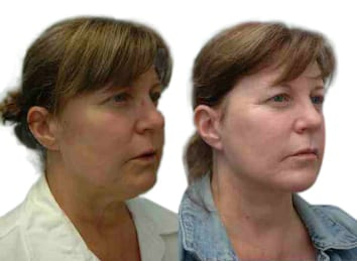 Facelift Before & After Gallery - Patient 843586 - Image 1