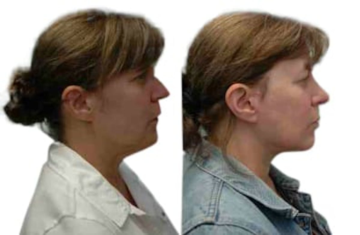 Facelift Before & After Gallery - Patient 843586 - Image 2
