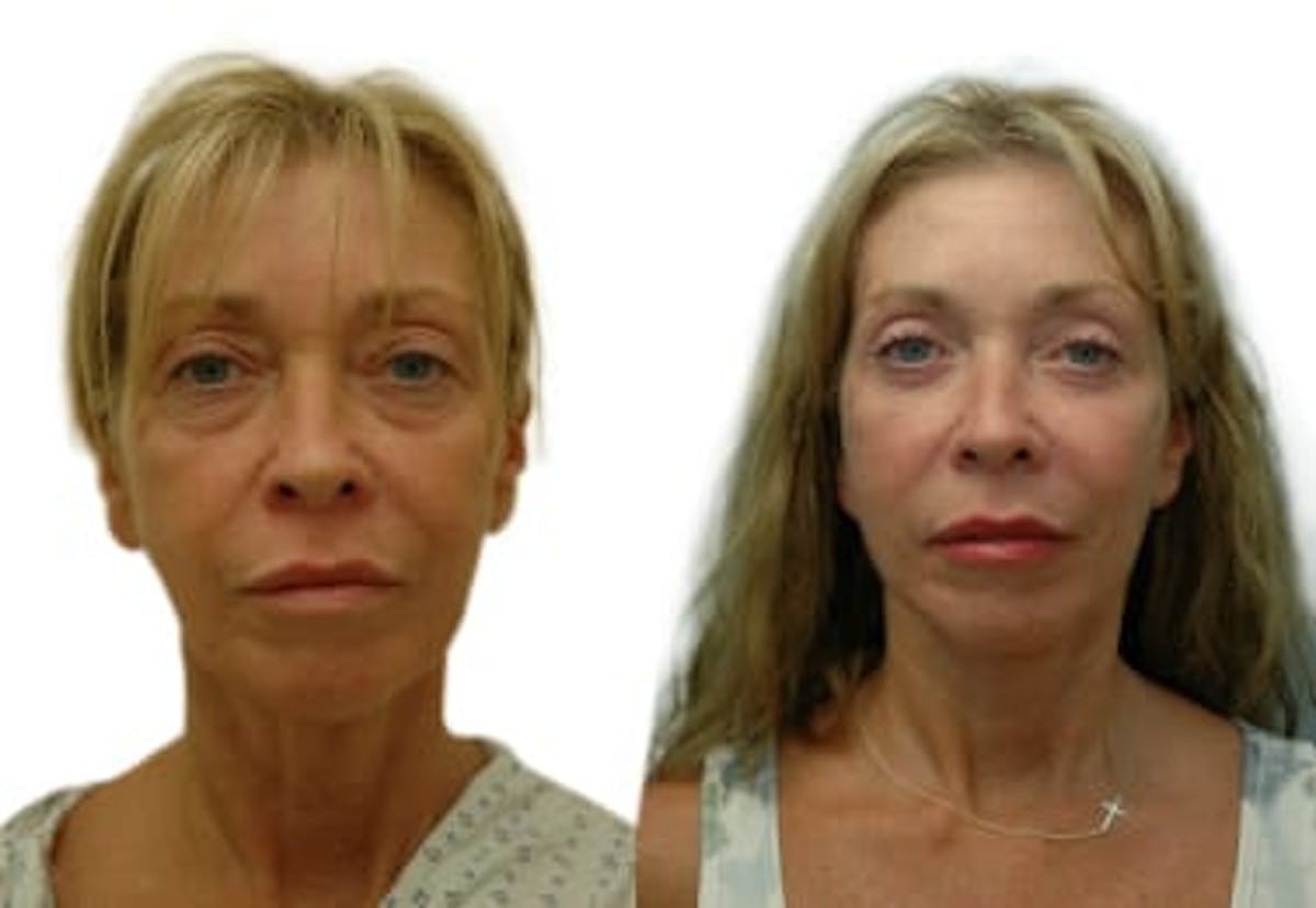 Facelift Before & After Gallery - Patient 117438 - Image 1