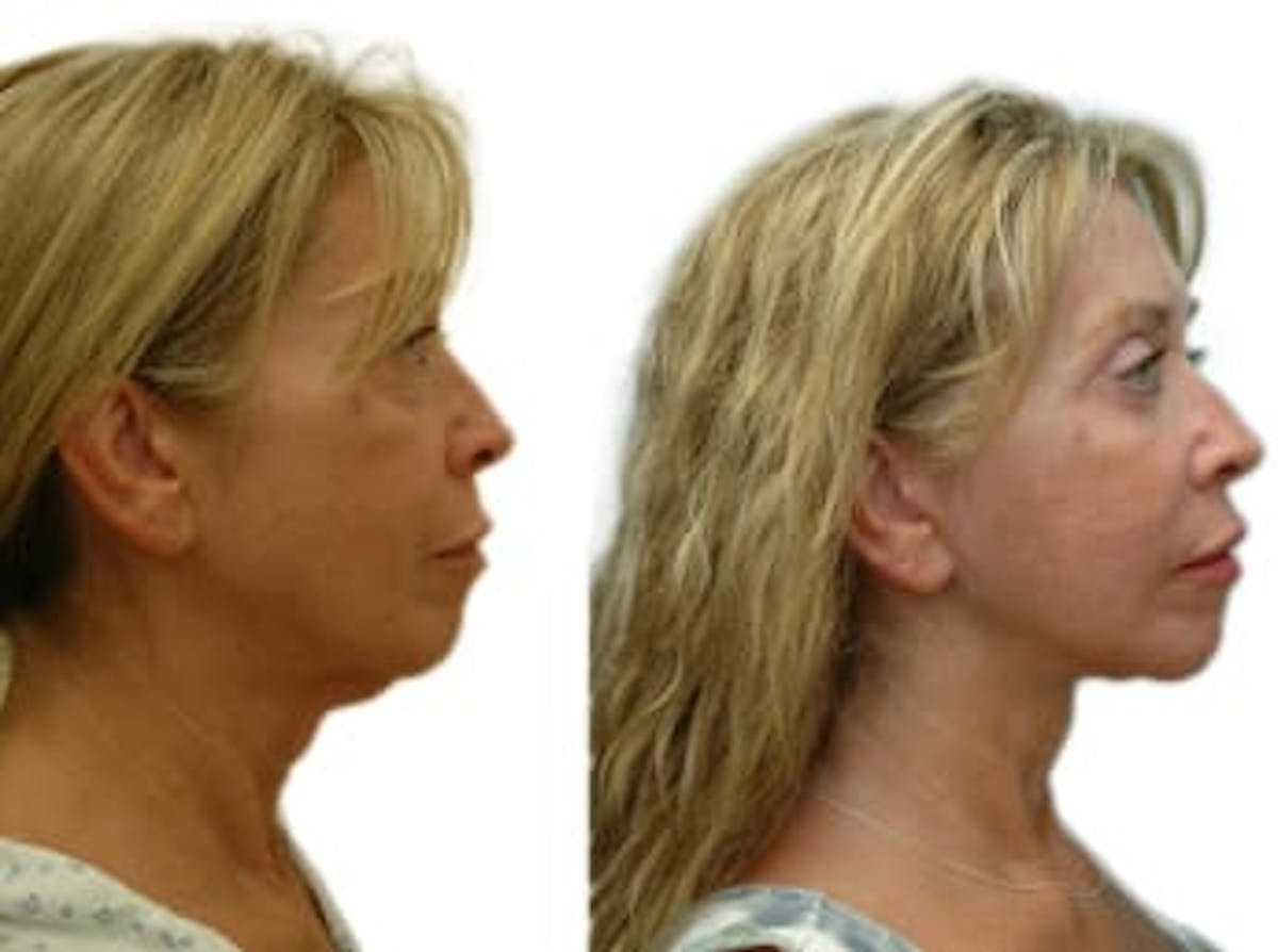 Facelift Before & After Gallery - Patient 117438 - Image 3