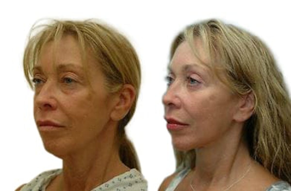 Facelift Before & After Gallery - Patient 117438 - Image 4