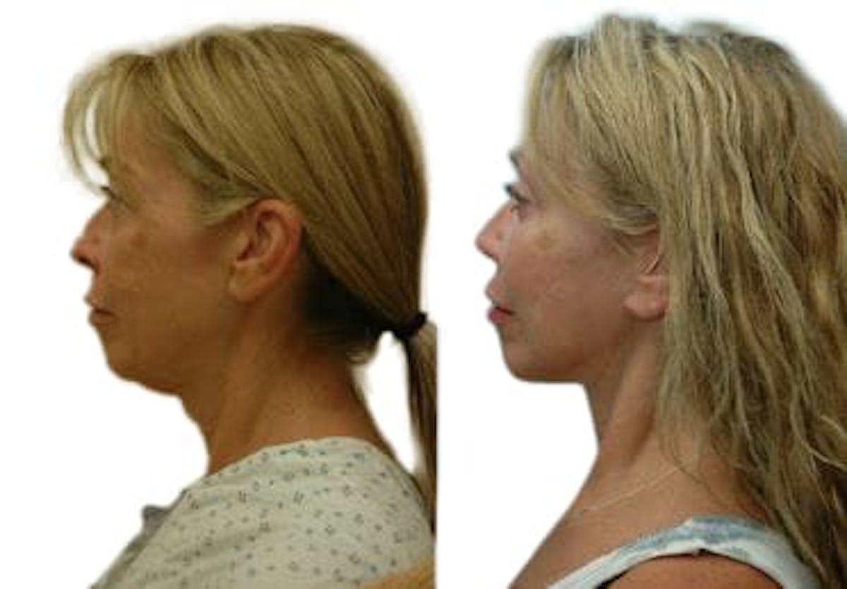 Facelift Before & After Gallery - Patient 117438 - Image 5