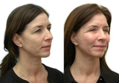 Facelift Before & After Gallery - Patient 146608 - Image 1