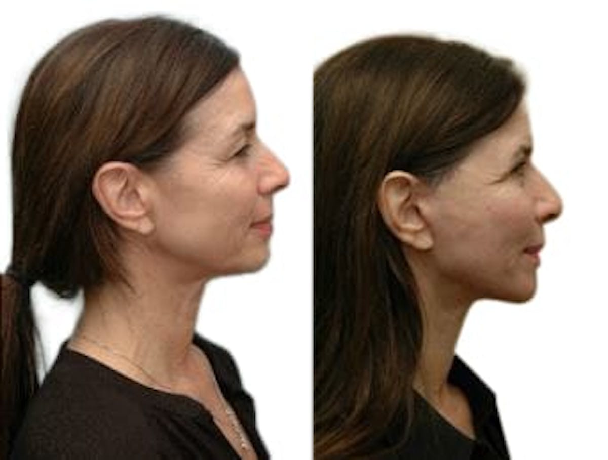 Facelift Before & After Gallery - Patient 146608 - Image 2