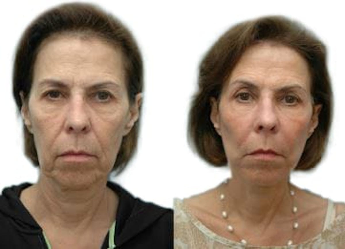 Facelift Before & After Gallery - Patient 238437 - Image 1