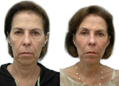 Facelift Before & After Gallery - Patient 238437 - Image 1