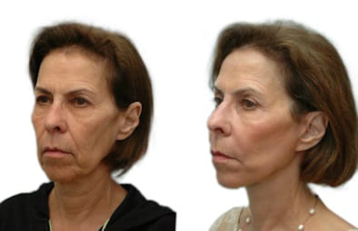 Facelift Before & After Gallery - Patient 238437 - Image 2
