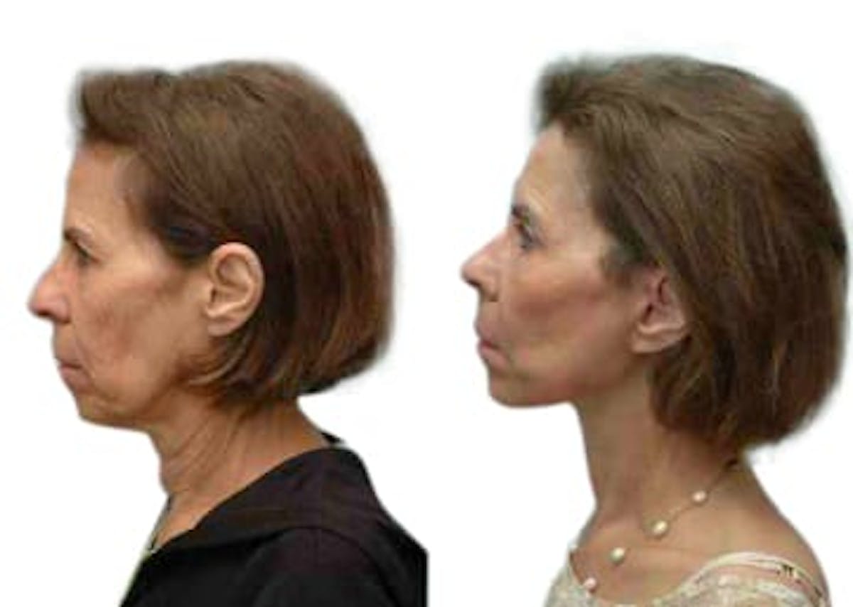 Facelift Before & After Gallery - Patient 238437 - Image 3