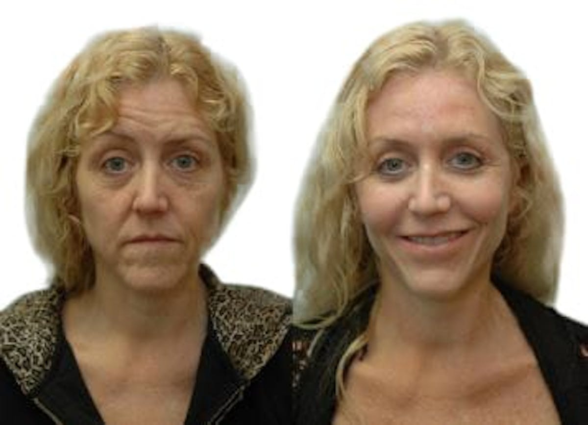 Facelift Before & After Gallery - Patient 127671 - Image 1