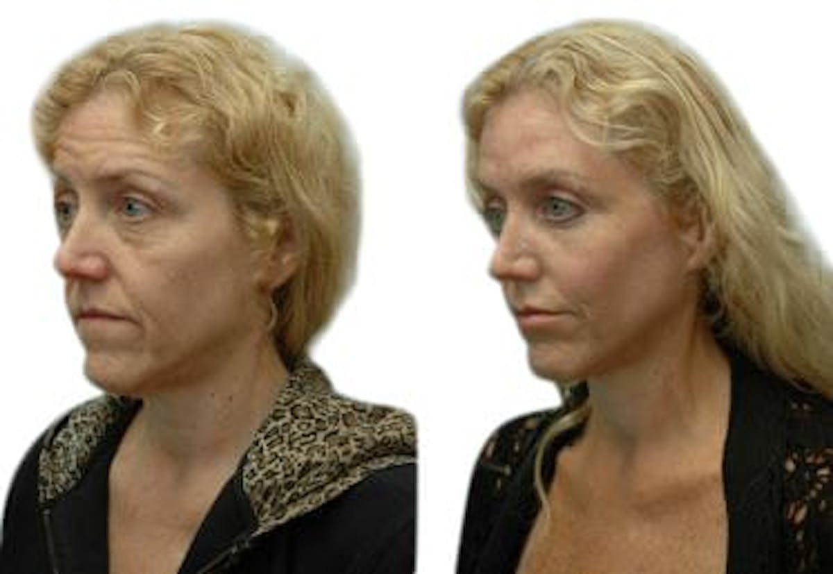 Facelift Before & After Gallery - Patient 127671 - Image 3