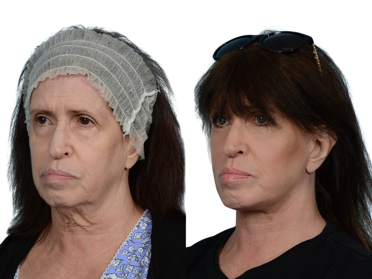 Facelift Before & After Gallery - Patient 393936 - Image 1