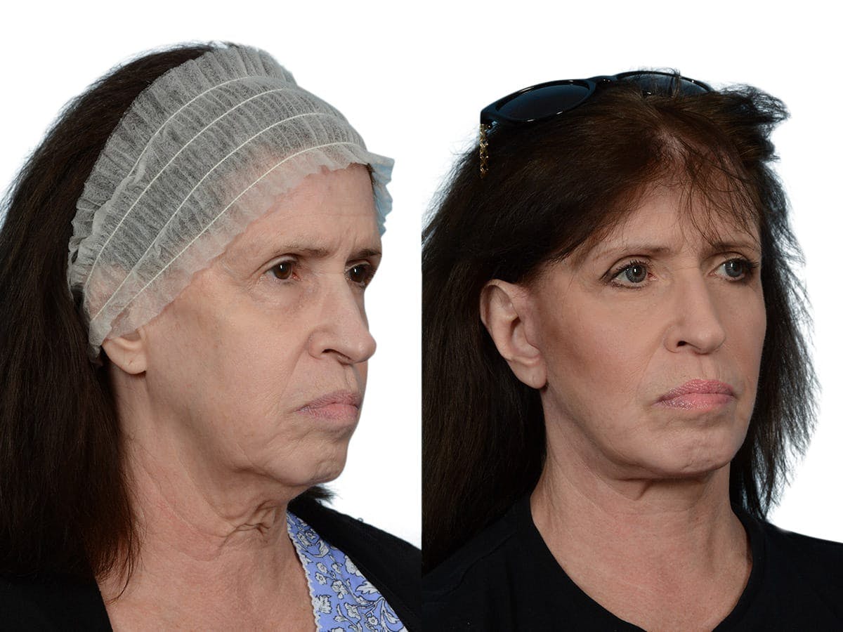 Facelift Before & After Gallery - Patient 393936 - Image 2