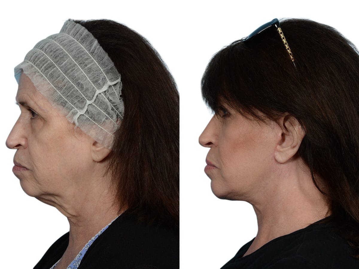 Facelift Before & After Gallery - Patient 393936 - Image 3