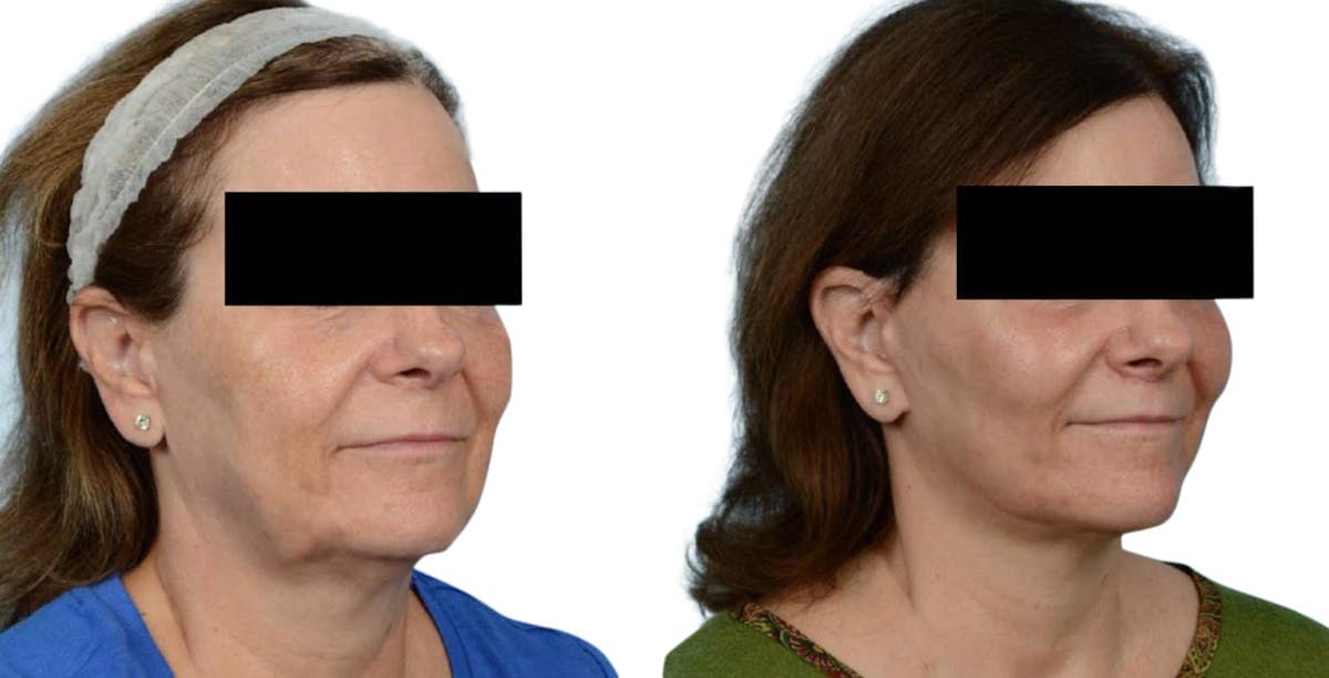 Facelift Before & After Gallery - Patient 396904 - Image 1