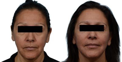 Facelift Before & After Gallery - Patient 628128 - Image 1