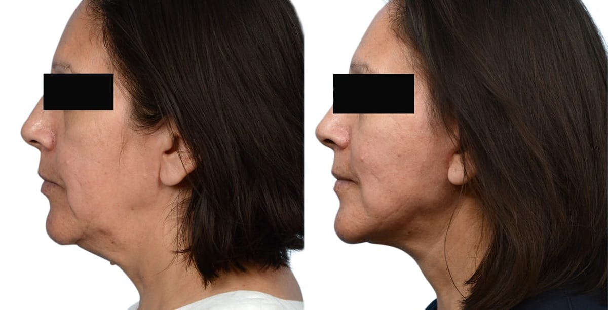 Facelift Before & After Gallery - Patient 628128 - Image 2