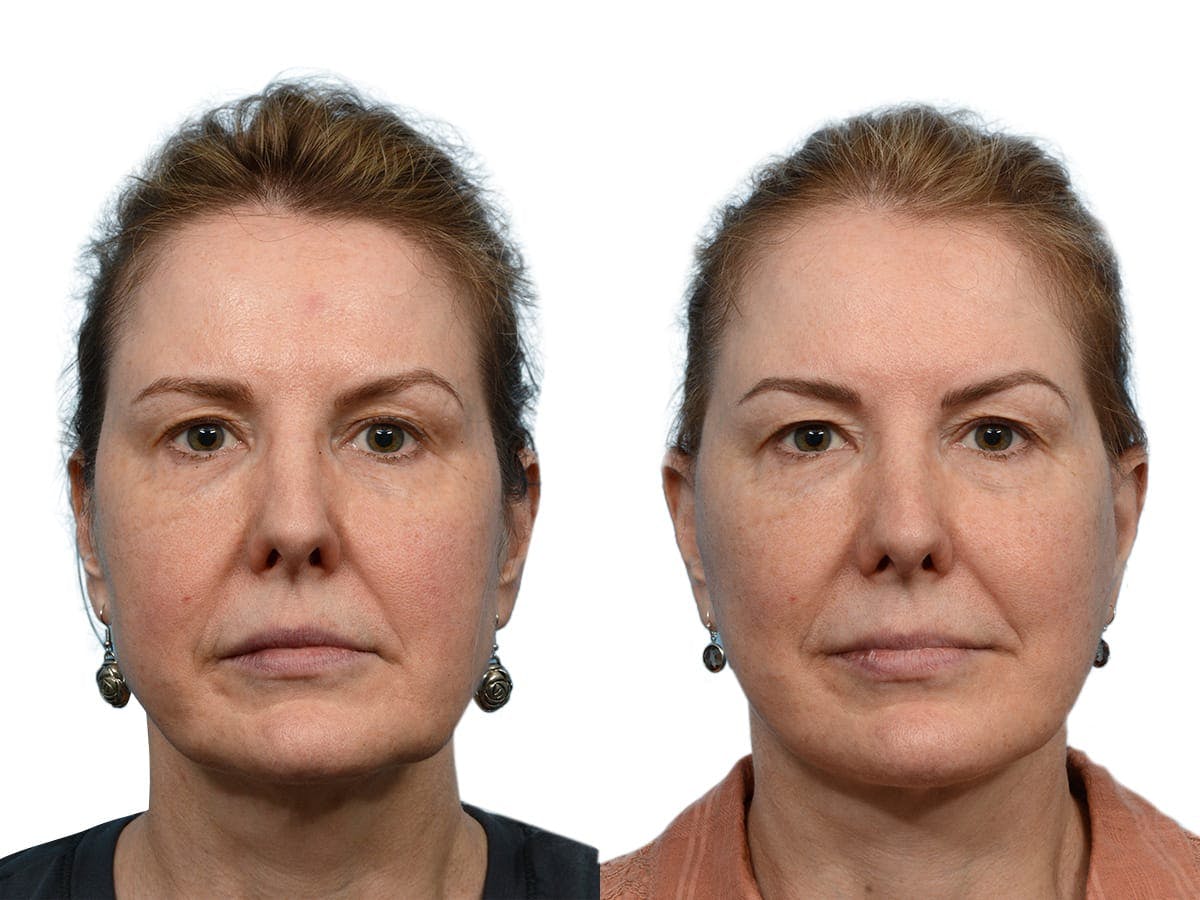 Facelift Before & After Gallery - Patient 212905 - Image 1