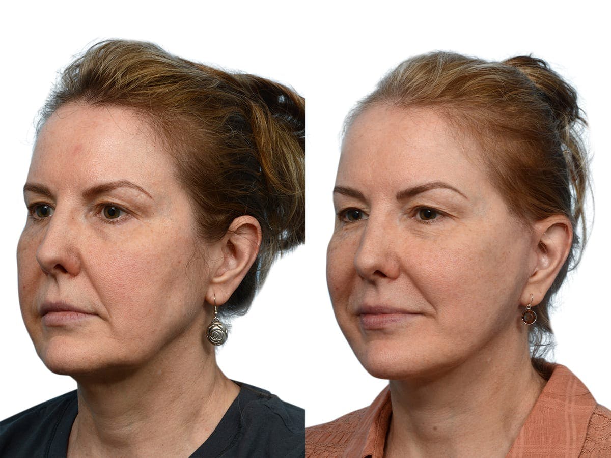 Facelift Before & After Gallery - Patient 212905 - Image 2